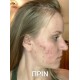 BEE FACTOR - Κεραλοιφή Για Ακμή & Σπυράκια – 30ml BEE FACTOR - Κεραλοιφή Για Ακμή & Σπυράκια – 30ml
