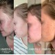 BEE FACTOR - Κεραλοιφή Για Ακμή & Σπυράκια – 30ml BEE FACTOR - Κεραλοιφή Για Ακμή & Σπυράκια – 30ml